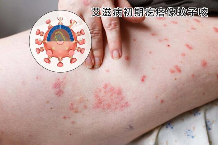此外,艾滋病最常见的表现之一就是皮肤病,因此,当发生高危性行为后