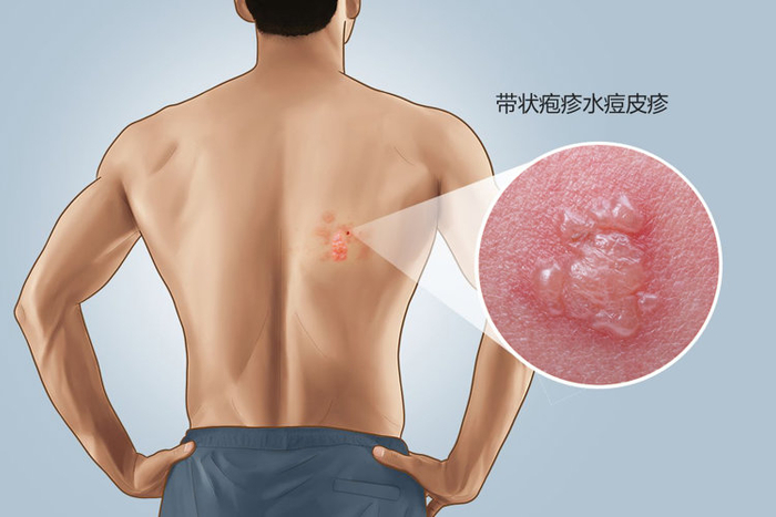 别不当回事|流感|带状疱疹|水疱_新浪新闻
