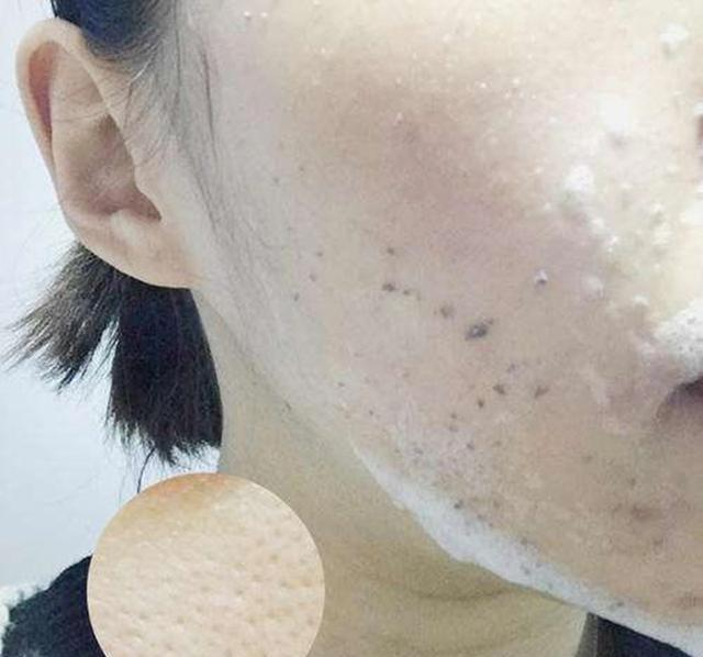 晒黑之后多久能恢复?怎么快速变白回来?