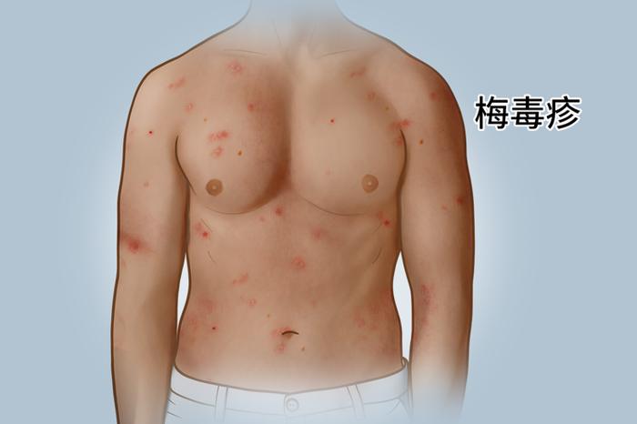 4,梅毒梅毒是由梅毒螺旋体引发的慢性,系统性传播疾病,梅毒患者的皮肤