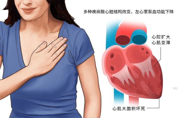 长期吃可能导致心力衰竭,提醒父母谨慎服用|心衰|心力衰竭|心脏_新浪