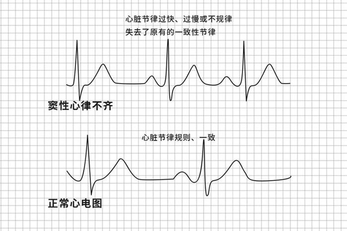 心律不齐的症状图片