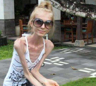 世界上最瘦的女人,身高158厘米体重却只有20公斤