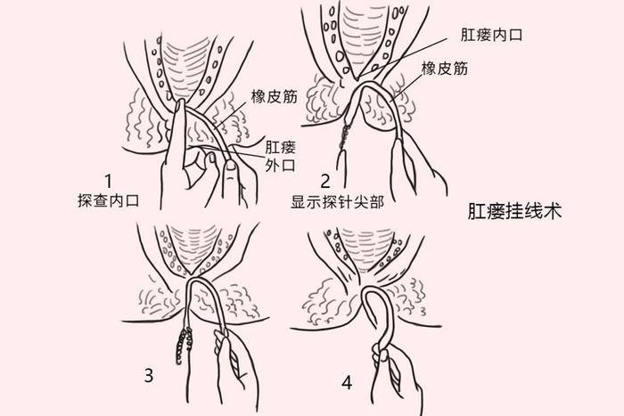 肛瘘手术动画演示图片