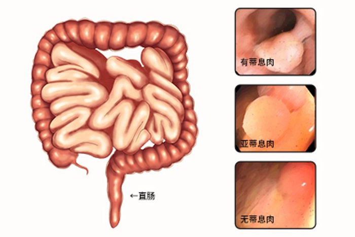 女子屁股痒,以为是痔疮强忍8年,做肠镜后,医生叹息:来得太晚|肠癌