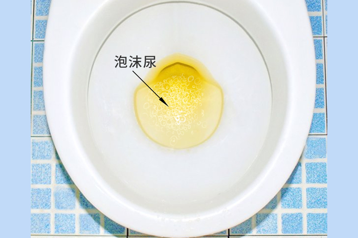 尿尿时为什么会出现泡沫?是肾出了问题?