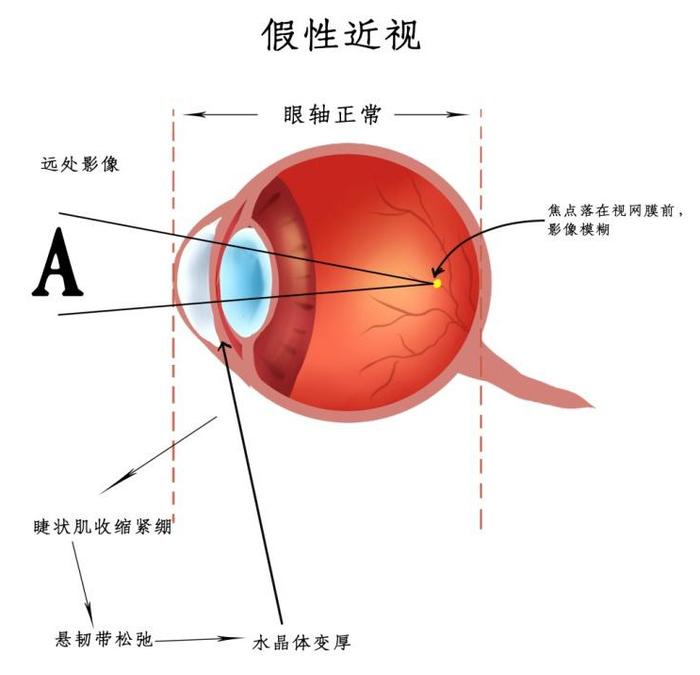 近视眼与正常眼图片