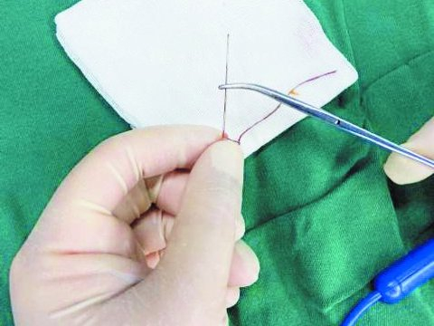 3厘米缝衣针“钻”进婴儿脊柱