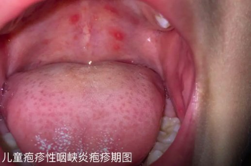 8摄氏度,吃药以后依旧高烧不退,送到医院后确诊为疱疹性咽峡炎.