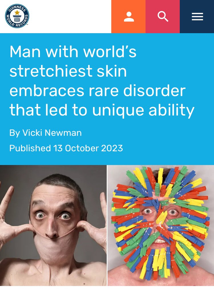 garryturner被吉尼斯世界纪录评为皮肤延展性最强的人