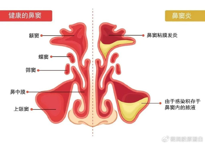 鼻窦与鼻窦炎有什么区别?Ⅲ型胶原蛋白修复受损鼻粘膜