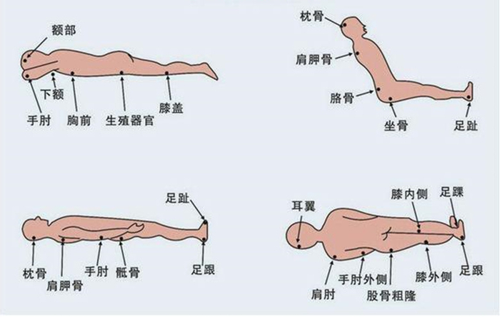 压疮好发于机体缺乏脂肪组织保护,无肌肉包裹或肌层较薄的骨突部位及