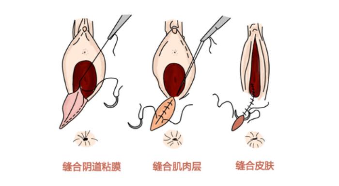 侧切切口愈合不良应该怎么办?