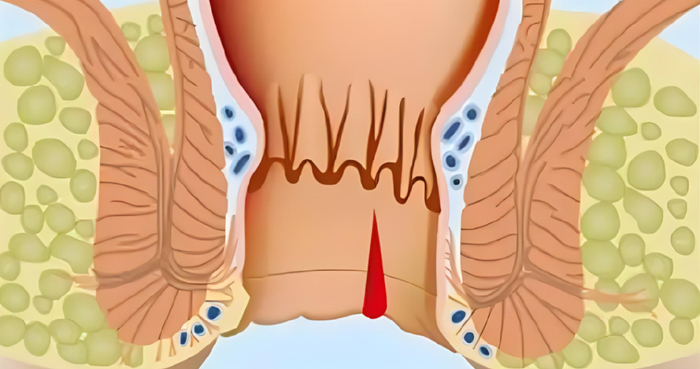 孕妈和产妇是痔疮的高发人
