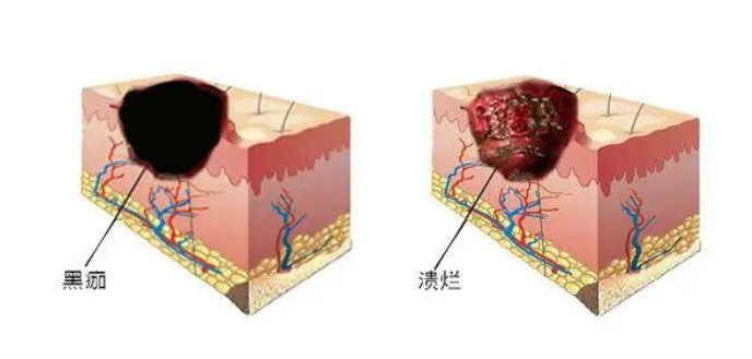 创面结痂一直不愈合是什么原因重组Ⅲ型人源化胶原蛋白促进创面愈合