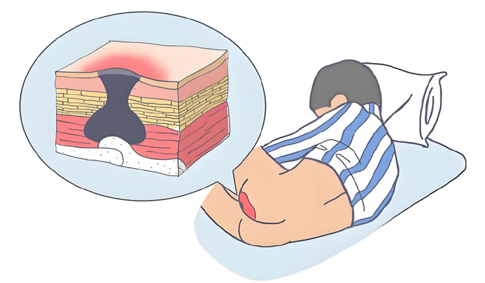 重组Ⅲ型人源化胶原蛋白促进压疮创面愈合!