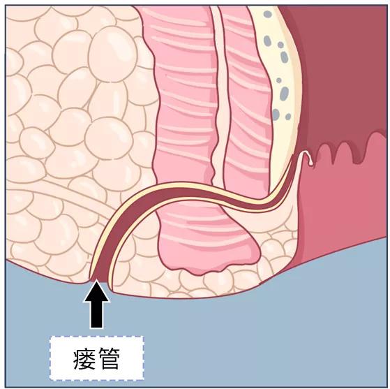 肛周脓肿根治手术图解图片