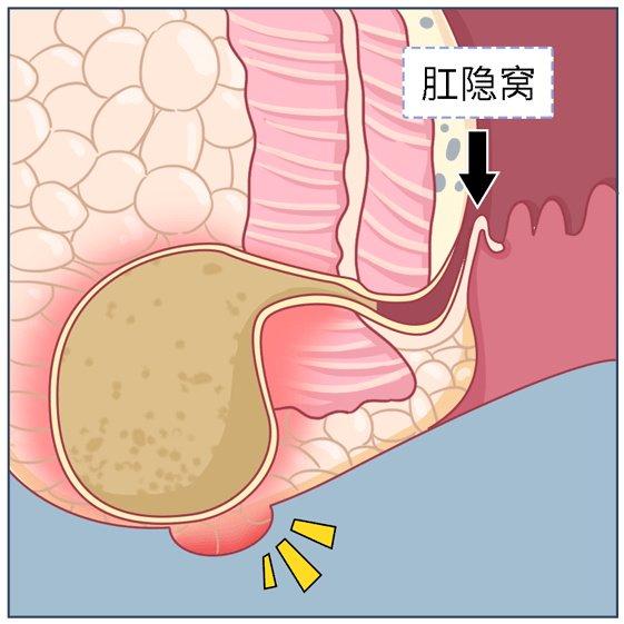 肛周脓肿是发生在肛门,肛管和直肠周围的急性化脓感染性疾病,它是由于