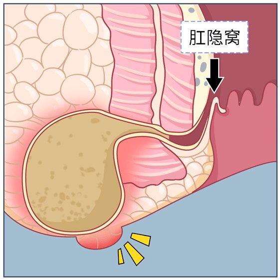 马蹄形肛周脓肿示意图图片