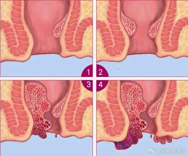 外痔疮肉芽图片