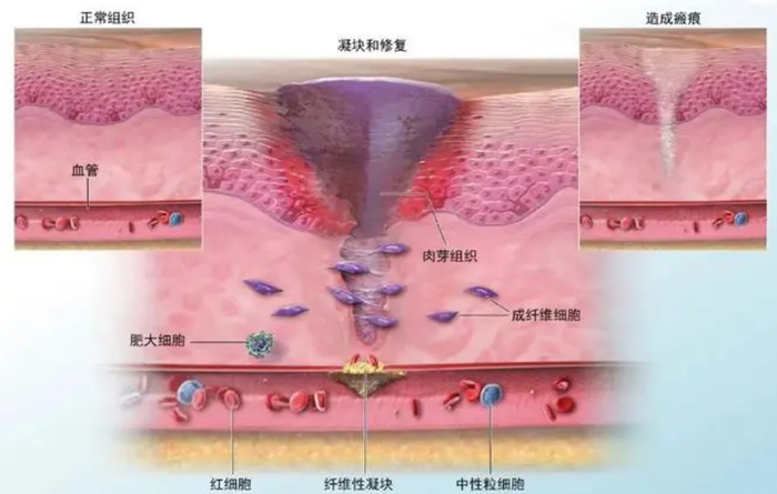 烧烫伤疤痕康复期要注意哪些?重组Ⅲ型人源化胶原蛋白抑制疤痕形成|疤痕增生|烧伤|创面|愈合|细度_新浪新闻