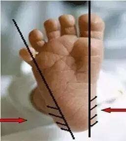 目前为新生儿筛查的遗传代谢病种有四种:1,苯丙酮尿症(简称pku)患病