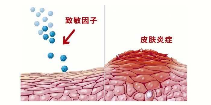 皮肤有炎症了，该怎么抗炎？重组Ⅲ型人源化胶原蛋白修复“受伤”肌肤|遮阳|色素沉着|蛋白酶|肌底|基础护肤_新浪新闻