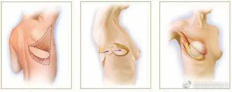 传统的放射状手术大多是以乳头为指向做放射状皮肤切口,以减少乳腺