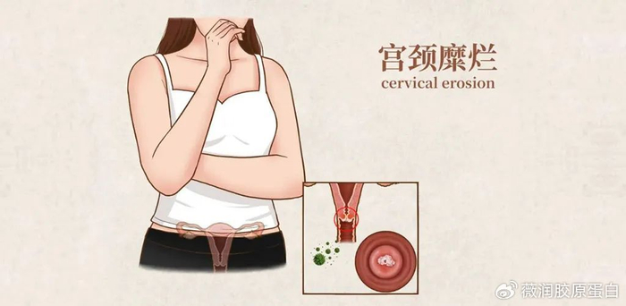 宫颈糜烂是"病"吗?薇润教你如何正确认识!
