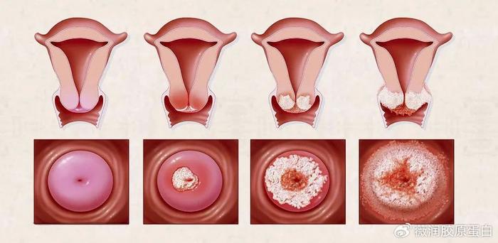 子宫颈外口糜烂图片