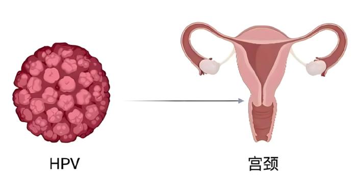 宫颈癌中期图片图片