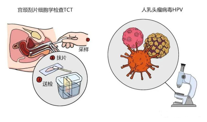 宫颈癌多是拖出来的酸酐化牛β乳球蛋白预防宫颈病变发生