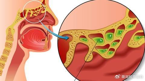 鼻炎老犯!多半是鼻粘膜损伤的问题!波特伽告诉你如何来预防!