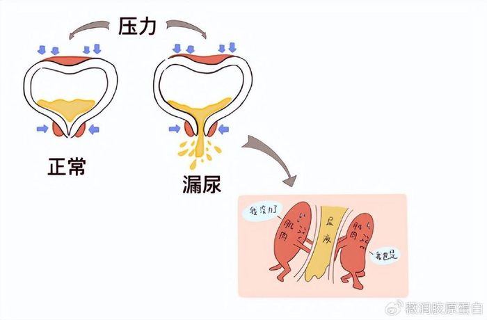 01,漏尿是一种病