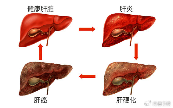 肝癌最多能活多少年?真实答案超出你想象|肝癌|黄金昶|患者_新浪新闻