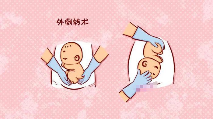 臀位也能顺产？医生徒手转胎头！胎位不正，到孕晚期纠正来得及吗