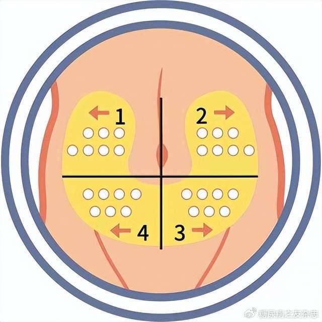 为什么你打胰岛素的地方硬硬的?