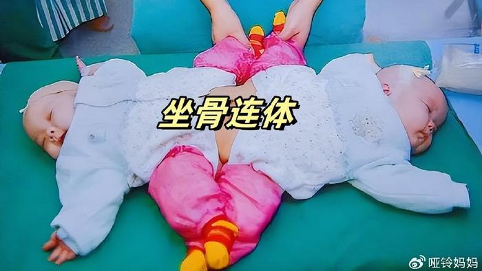 中国第一例“坐骨连体婴儿”成功分离，15年后咋样了？有些遗憾