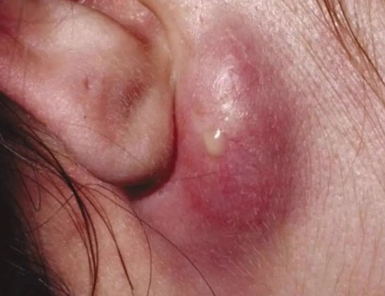 耳朵后起的"硬包",首先考虑是这种感染|瘢痕疙瘩|硬包|疖子_新浪新闻
