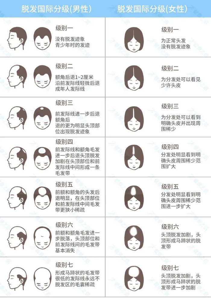针对治疗方案也是不同的,大家可以根据下面这张"脱发等级图",先判断一