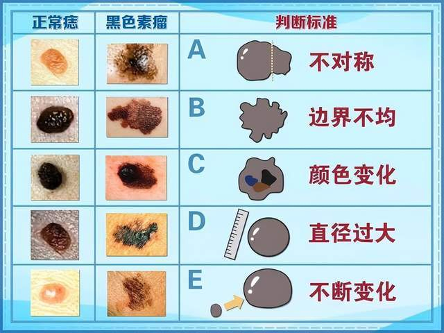 歌手张恒远因黑色素瘤去世，普通痣是怎么癌变的？|张恒远|黑色素瘤|黑痣_新浪新闻