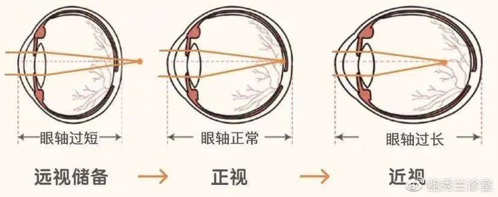 孩子远视储备不足就是要近视了吗?不想娃近视,一定要做好这4点