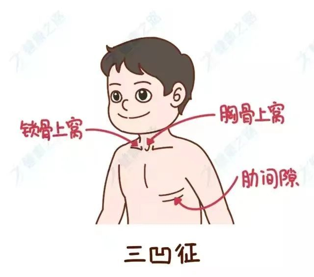 一直咳咳咳，会变成肺炎吗？医生：这4种情况要当心！|肺炎|咳嗽
