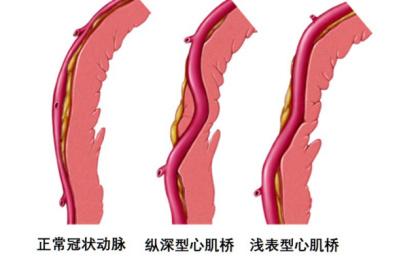 需要治疗吗?|心肌|冠脉|患者_新浪新闻