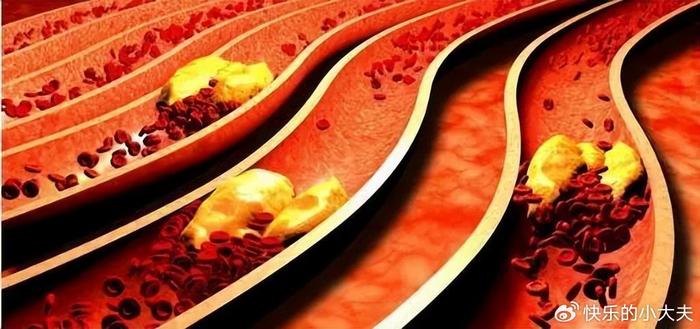 2. 高低密度脂蛋白(ldl)膽固醇:被稱為