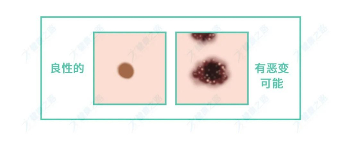 无论男女,身上长这 3 种痣多半要癌变,一定要留意!