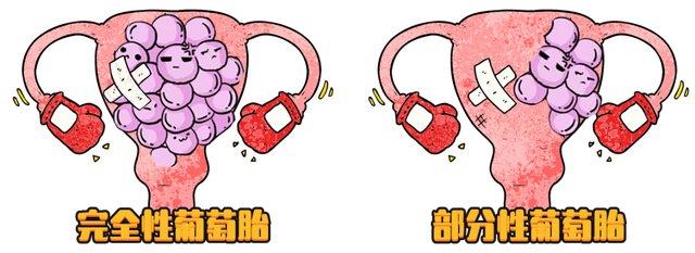 葡萄胎图片是胎儿吗图片