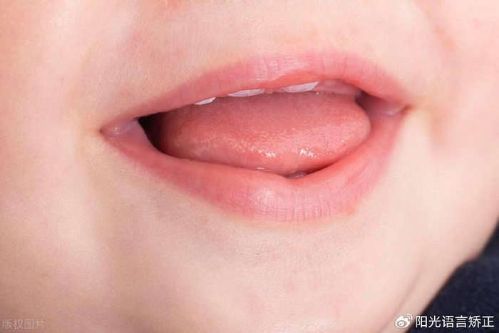 语言矫正:宝宝舌系带过短,三个影响别忽视|舌系带|发育|宝宝_新浪新闻