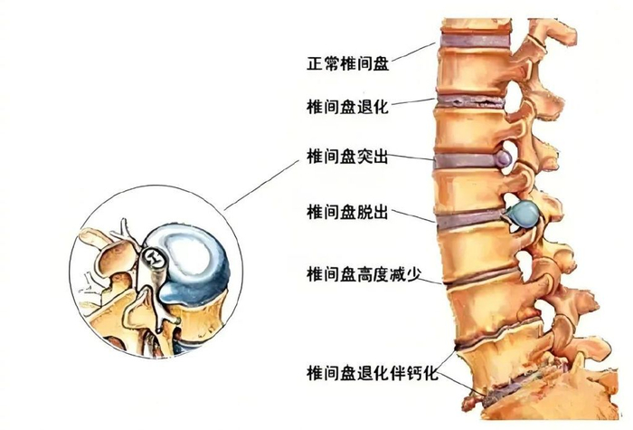 腰痛|臀部|腰椎_新浪新闻