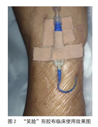 降低picc 脱管率,"笑脸"形胶布导管外固定法了解一下~|输液|贴膜|敷贴